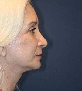 Facelift Before & After