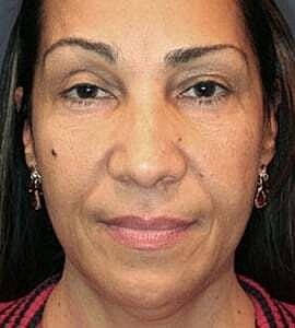Facelift Before & After