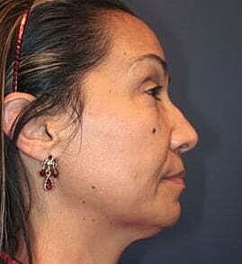 Facelift Before & After