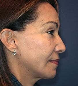 Facelift Before & After