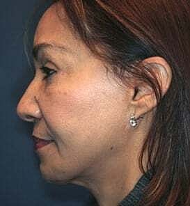 Facelift Before & After