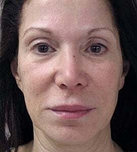 Facelift Before & After