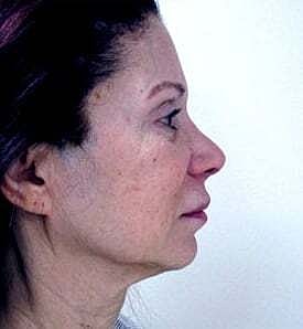Facelift Before & After