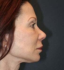 Facelift Before & After