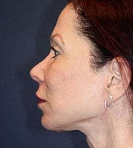 Facelift Before & After