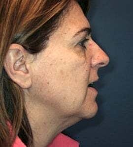Facelift Before & After