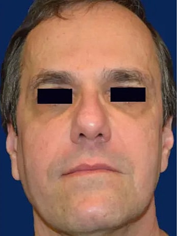 Cheeck Fillers Before and After
