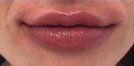 Lip Filler Before & After
