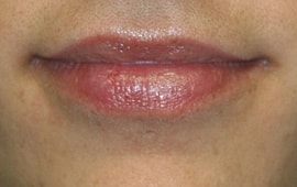 Lip Filler Before & After