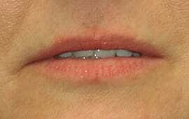 Lip Filler Before & After