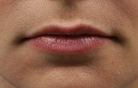 Lip Filler Before & After