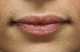 Lip Filler Before & After