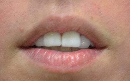 Lip Filler Before & After