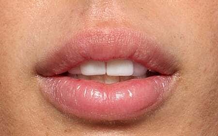 Lip Filler Before & After