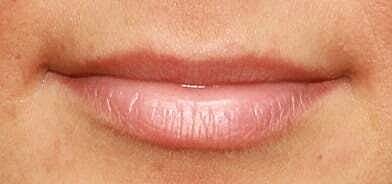 Lip Filler Before & After