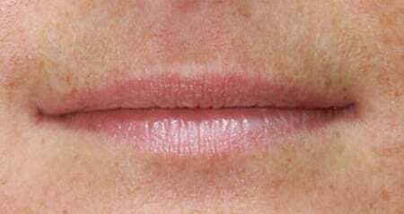 Lip Filler Before & After