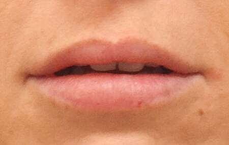 Lip Filler Before & After