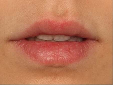Lip Filler Before & After