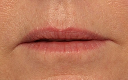 Lip Filler Before & After