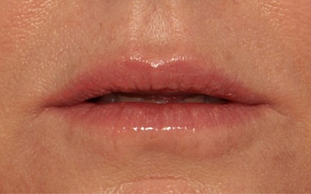 Lip Filler Before & After
