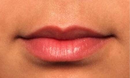 Lip Filler Before & After