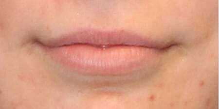 Lip Filler Before & After