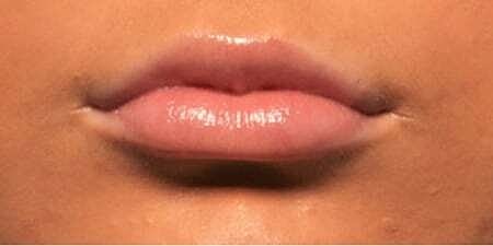 Lip Filler Before & After