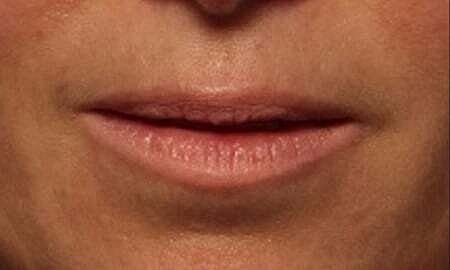 Lip Filler Before & After