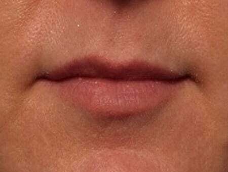 Lip Filler Before & After