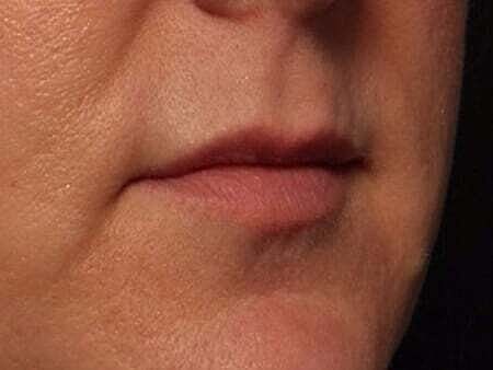 Lip Filler Before & After