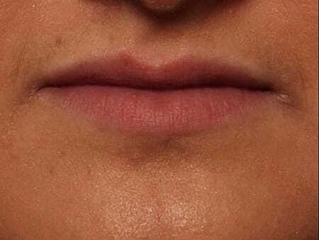 Lip Filler Before & After