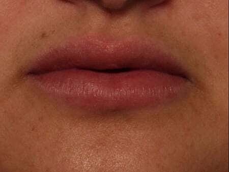 Lip Filler Before & After