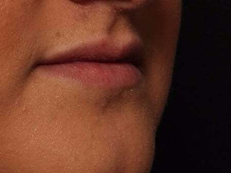 Lip Filler Before & After