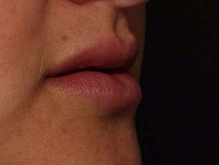 Lip Filler Before & After