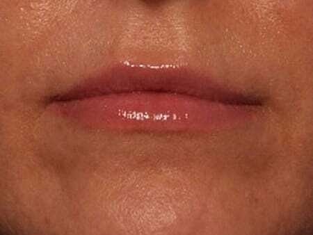 Lip Filler Before & After