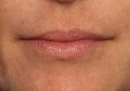 Lip Filler Before & After