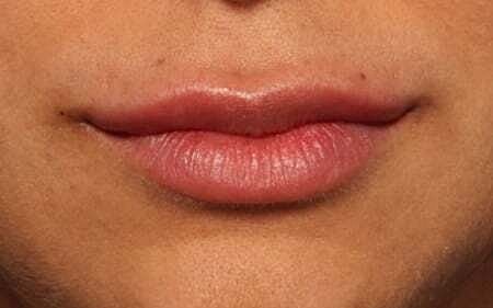 Lip Filler Before & After