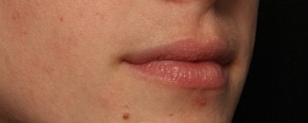 Lip Filler Before & After