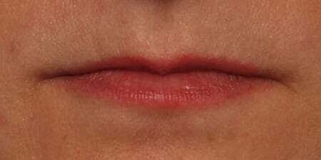 Lip Filler Before & After