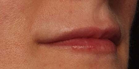 Lip Filler Before & After