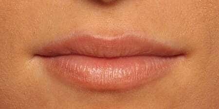 Lip Filler Before & After