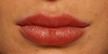 Lip Filler Before & After
