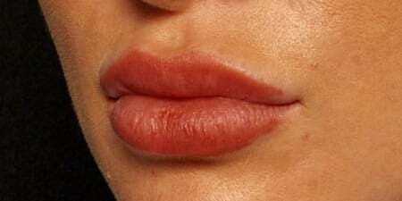 Lip Filler Before & After