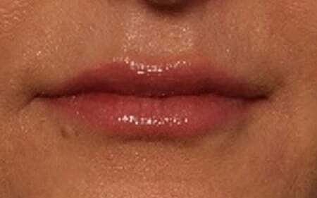 Lip Filler Before & After