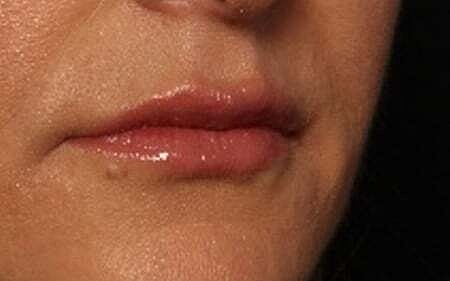 Lip Filler Before & After