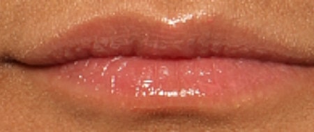 Lip Filler Before & After