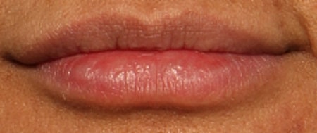 Lip Filler Before & After