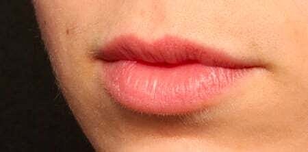 Lip Filler Before & After