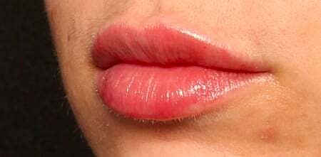 Lip Filler Before & After