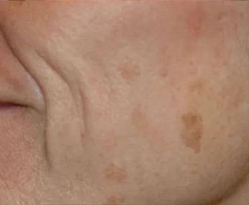 Before and After Lutronic Hollywood Spectra